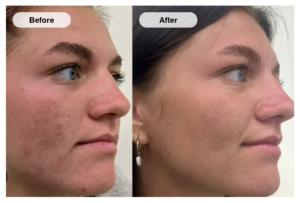 Microneedling Before and After